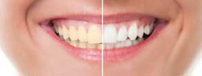 Le Cabinet dentaire Cibell vous reçoit près de Lyon pour une étude de vos dents. Spécialistes en esthétique du sourire, les chirurgiens-dentistes Cibell trouveront avec vous la bonne teinte et pratiqueront un blanchiment de vos dents naturel.