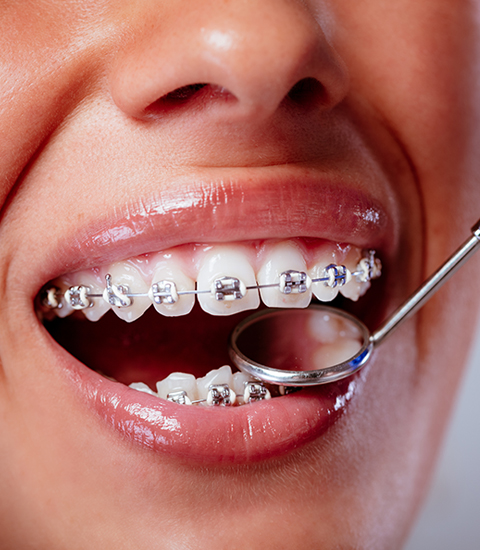 Soins dentaires - Orthodontie